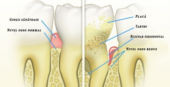 Periodontal-Disease-ro-820×420