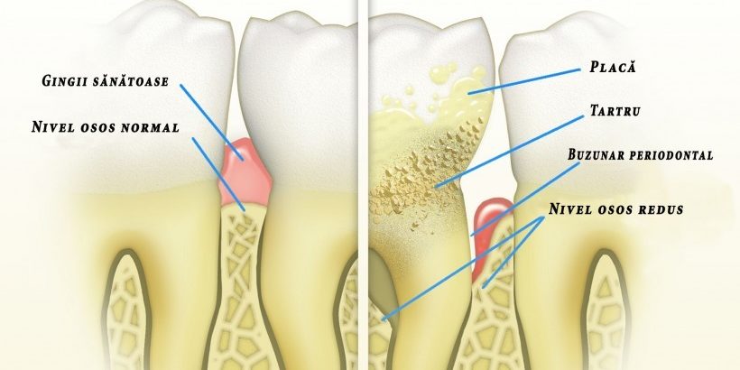 Periodontal-Disease-ro-820×420