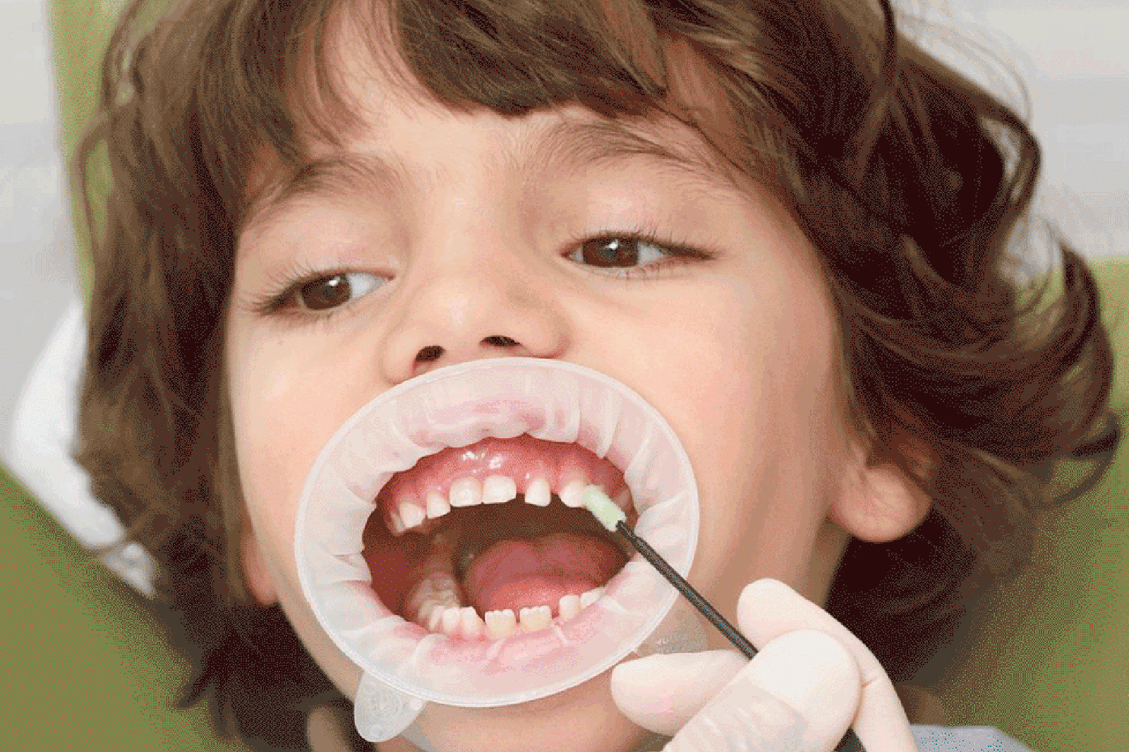 Ребенок без молочных зубов. Черные молочные зубы у детей.